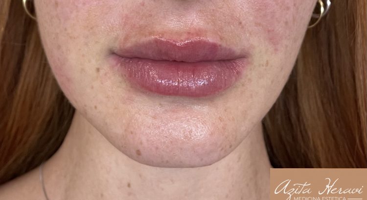 Filler labbra con acido ialuronico
