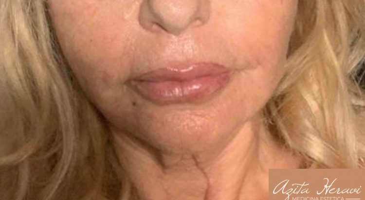 BioLinWrap. Lifting viso non chirurgico