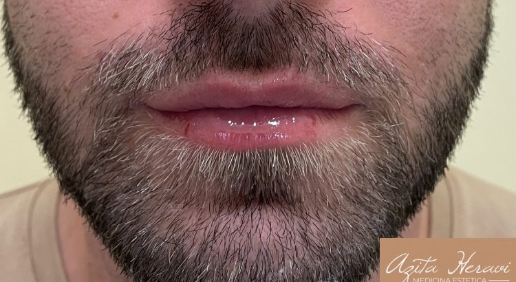 Rimodellamento labbra senza filler