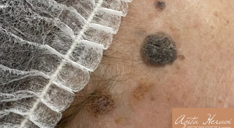 Rimozione cheratosi seborrica con plasma exeresi